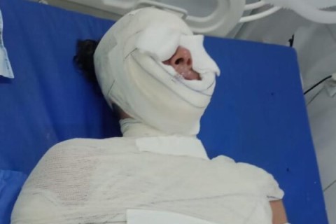 Mulher sofre queimadura de 2° grau após panela de pressão explodir